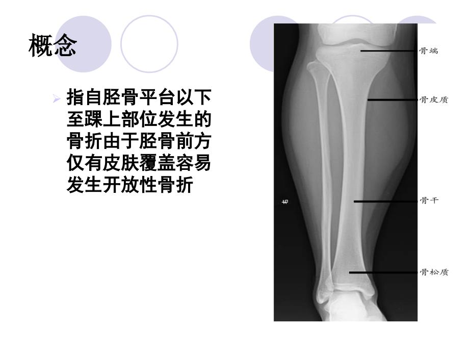 胫腓骨2012052910133047_第2页