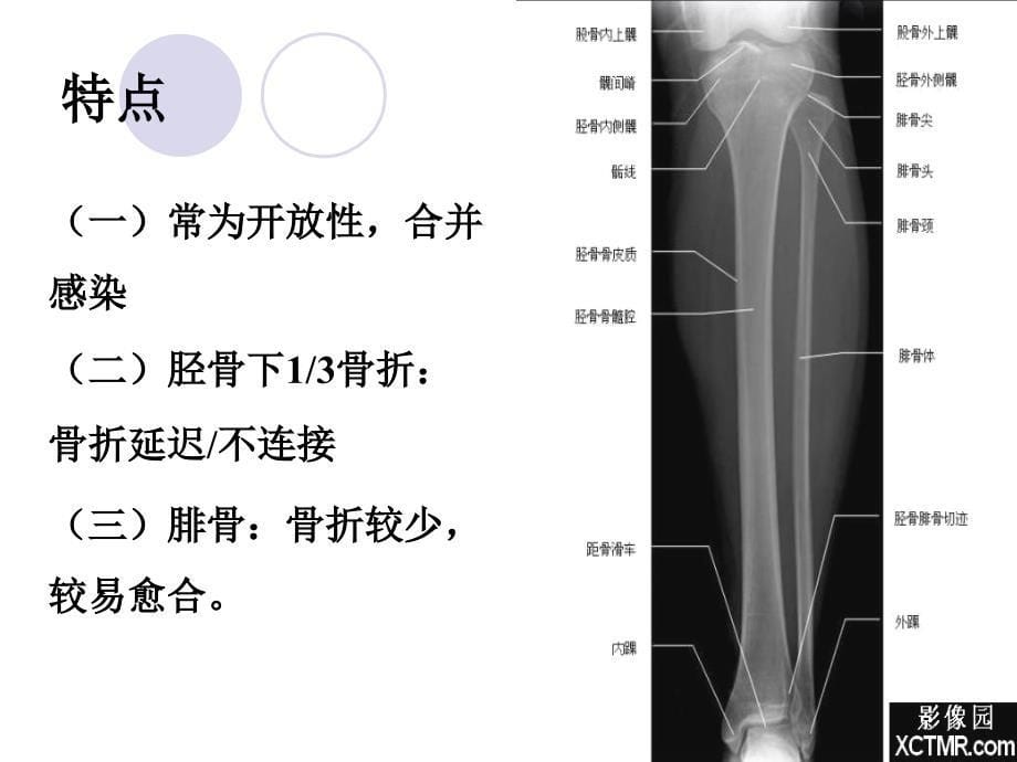 胫腓骨2012052910133047_第5页