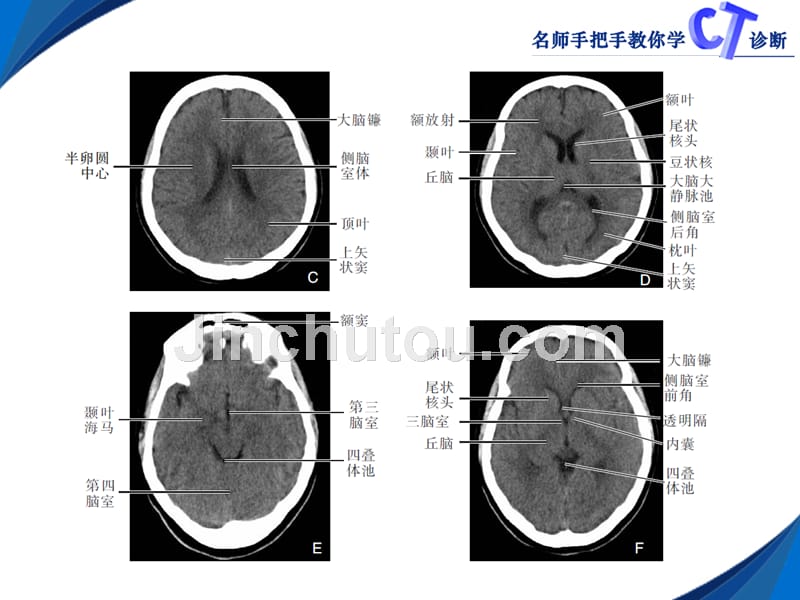 颅-脑ct影像学表现_第3页