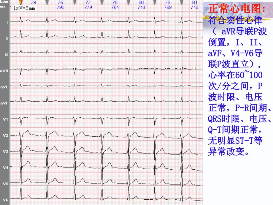 实习生心电图基础知识教案三-常见心电图诊断_第4页