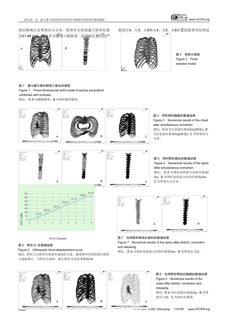 漏斗胸与脊柱侧弯同时矫形对胸廓变形影响的数值模拟_第4页