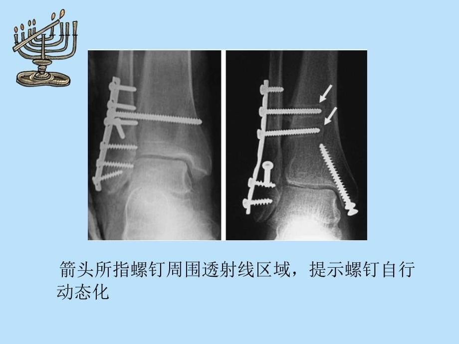 3皮质固定与4皮质固定_第5页