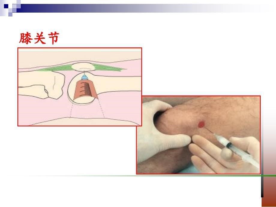 关节腔穿刺与关节液检验_第5页