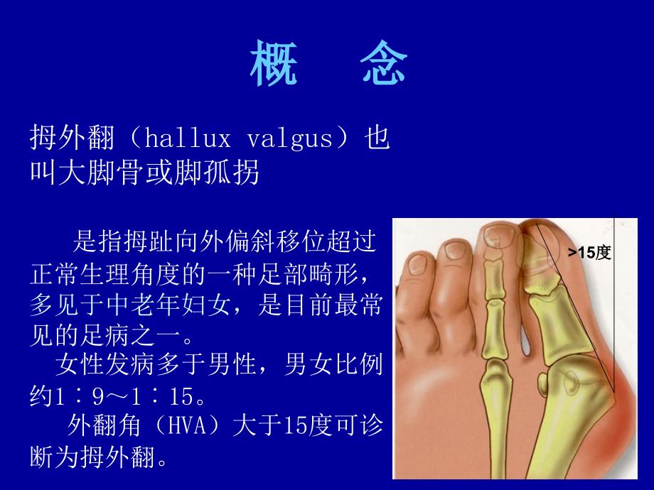 拇外翻的概念与分型_第2页