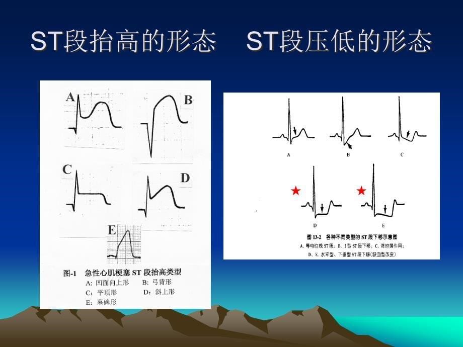 危重心电图_第5页