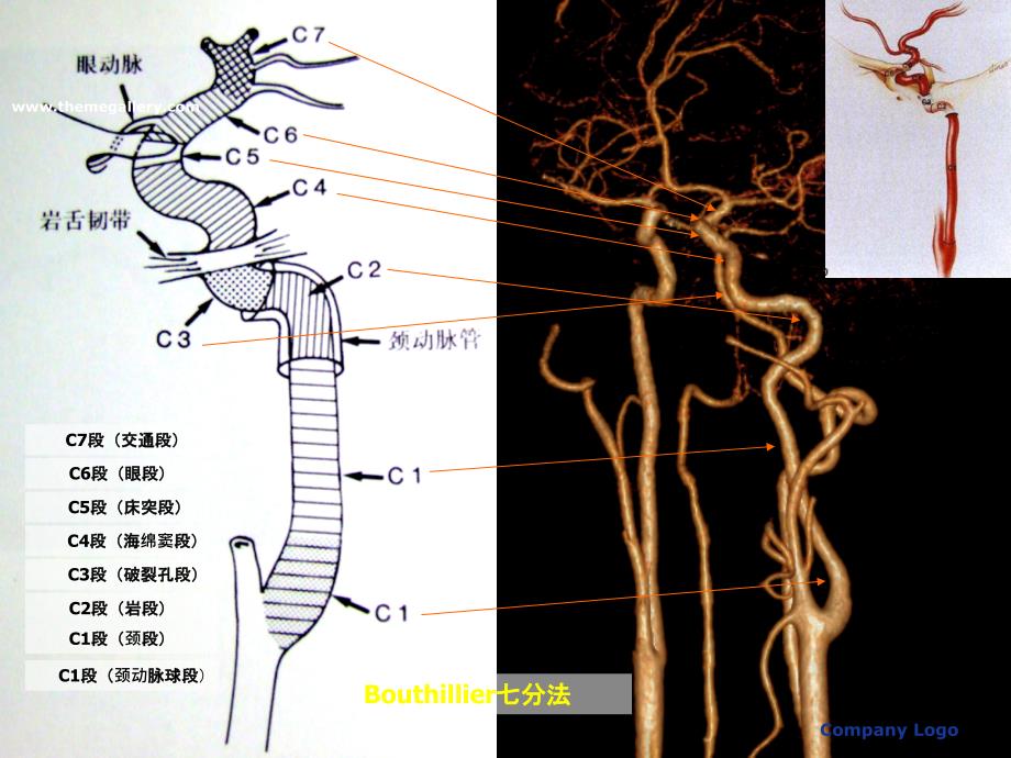 脑血管解剖及dsa阅片解读_第4页