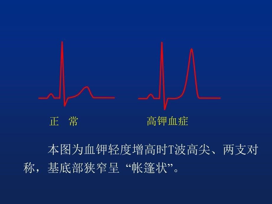 电解质紊乱和药物对心电图影响_第5页