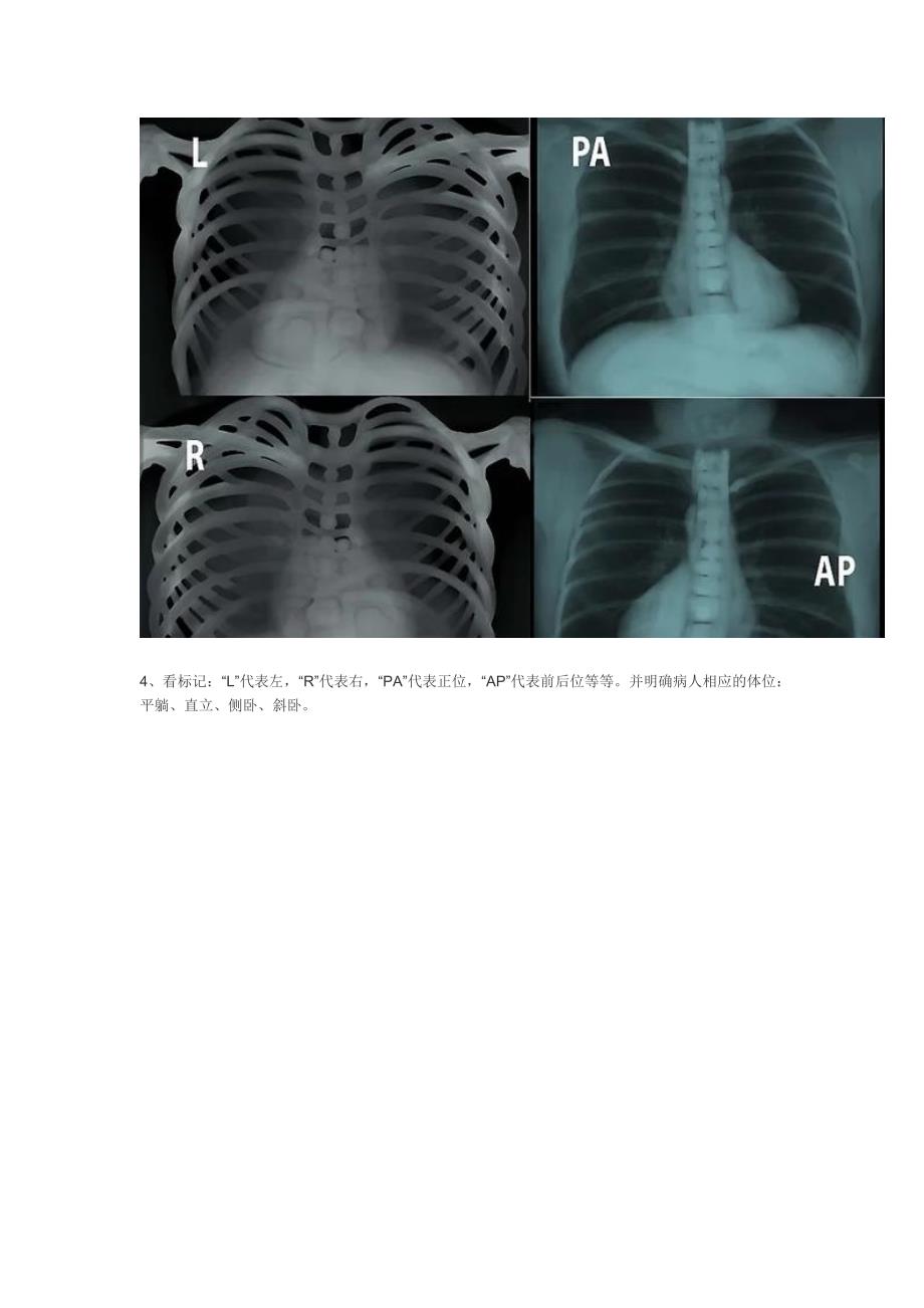 怎么看胸片_第4页