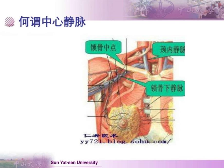 全面了解中心静脉置管及护理_第2页