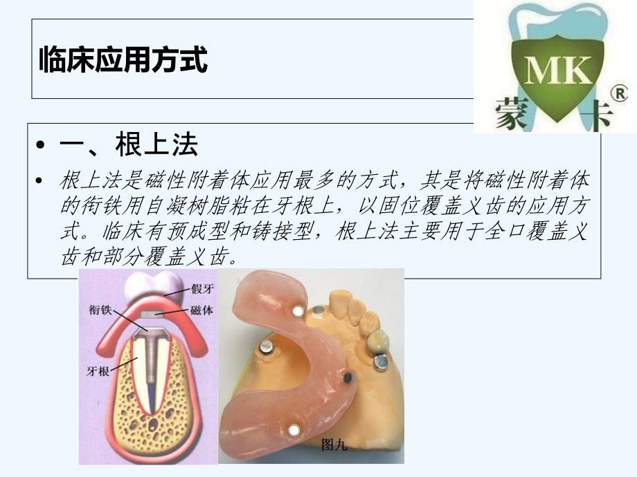 口腔磁性附着体安装方法_第3页