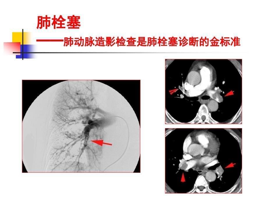 肺栓塞的ct_第5页