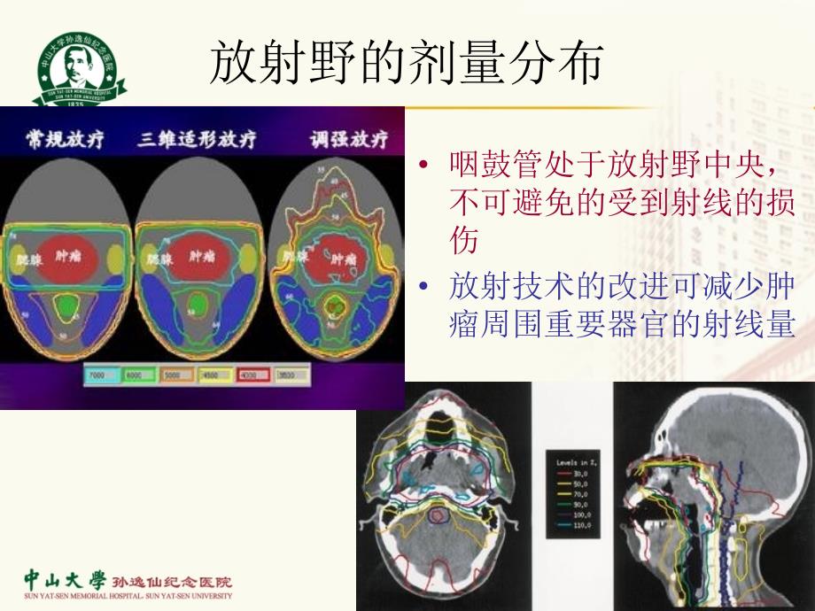 npc放疗后咽鼓管损伤与治疗_第4页