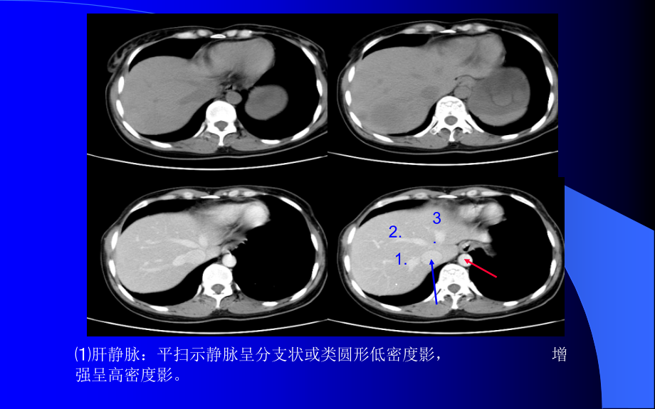 腹部ct解剖及诊断(速成)_第4页