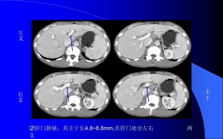 腹部ct解剖及诊断(速成)_第5页