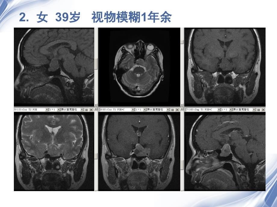 医学影像垂体瘤mr诊断与鉴别_第5页