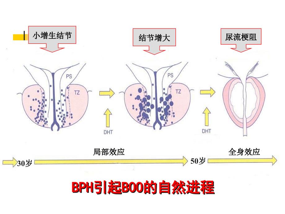 bph临床进展性与其治疗策略_第2页