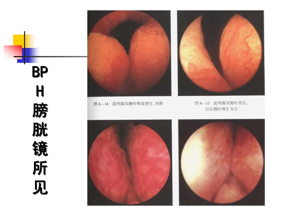 bph临床进展性与其治疗策略_第3页