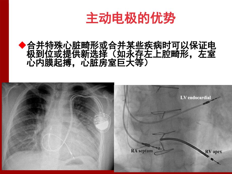 主动电极并发症与预防于波_第3页