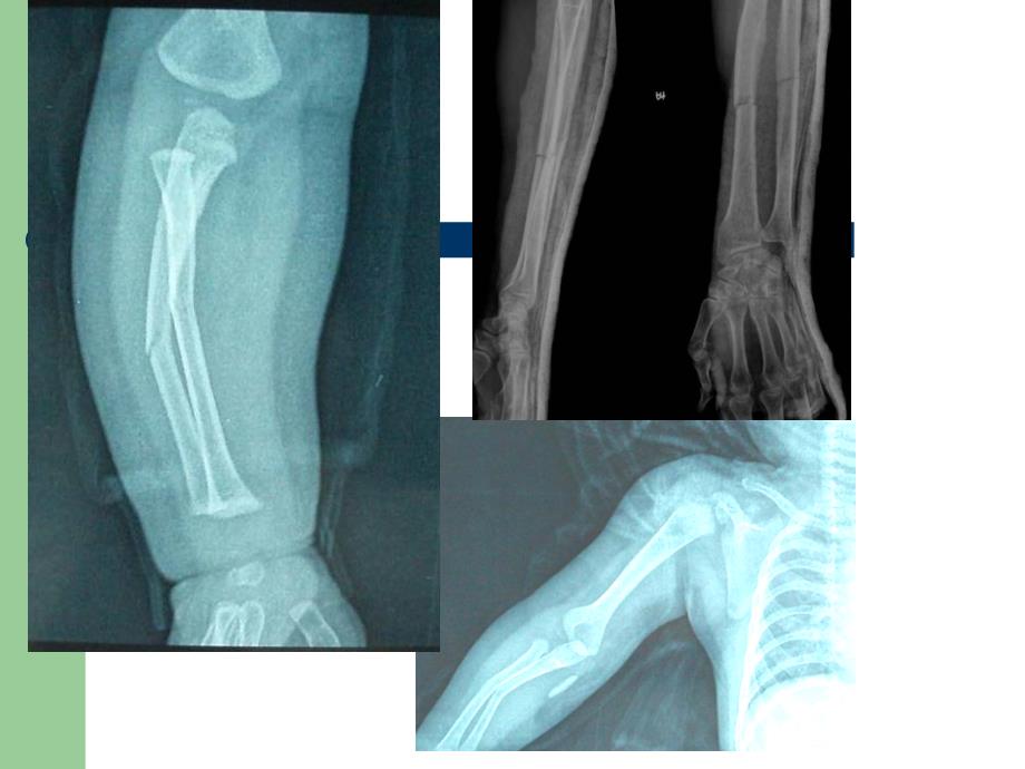 前臂常见骨折手术_第4页