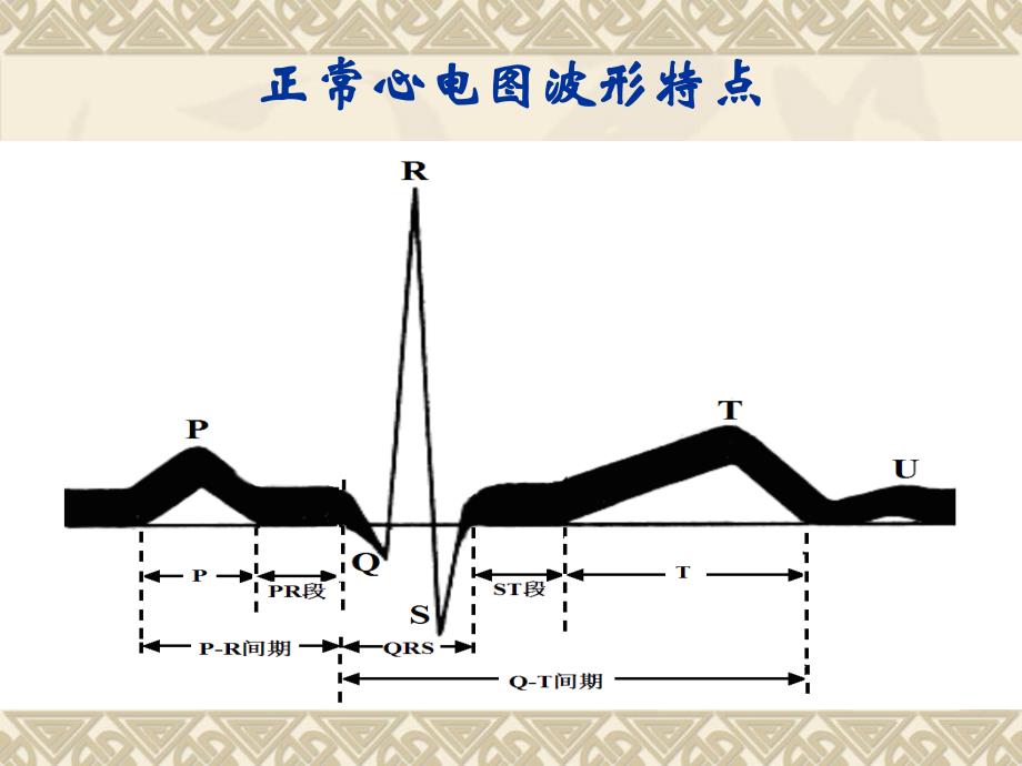 护理人员常见异常心电图识别与处理方法_第4页