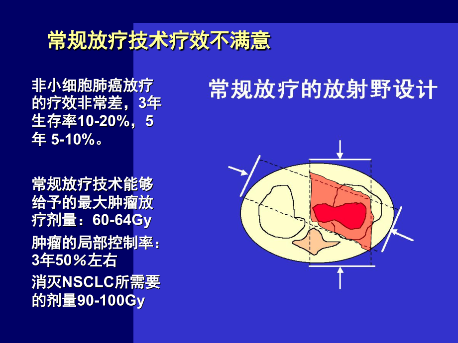 蒋国梁肺癌三维适形与调强放射治疗_第2页