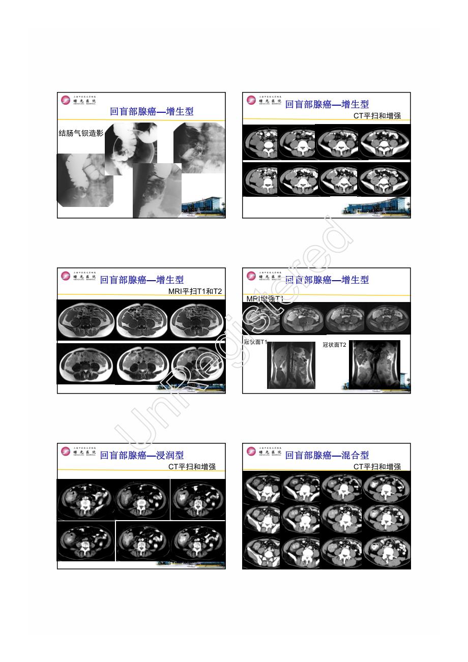 詹松华回盲部肿瘤与肿瘤样病变鉴别诊断_第2页