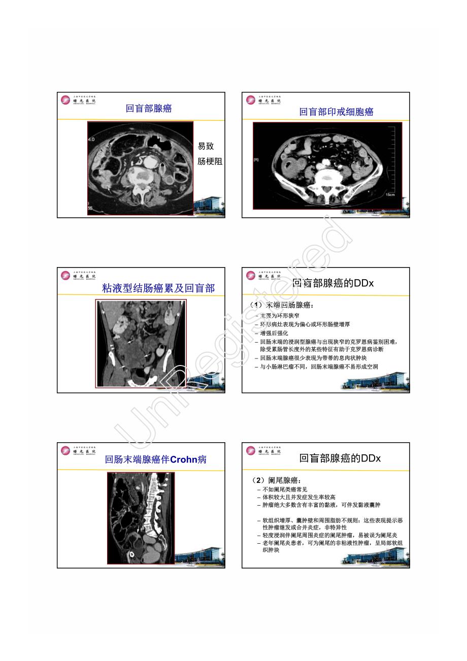 詹松华回盲部肿瘤与肿瘤样病变鉴别诊断_第3页