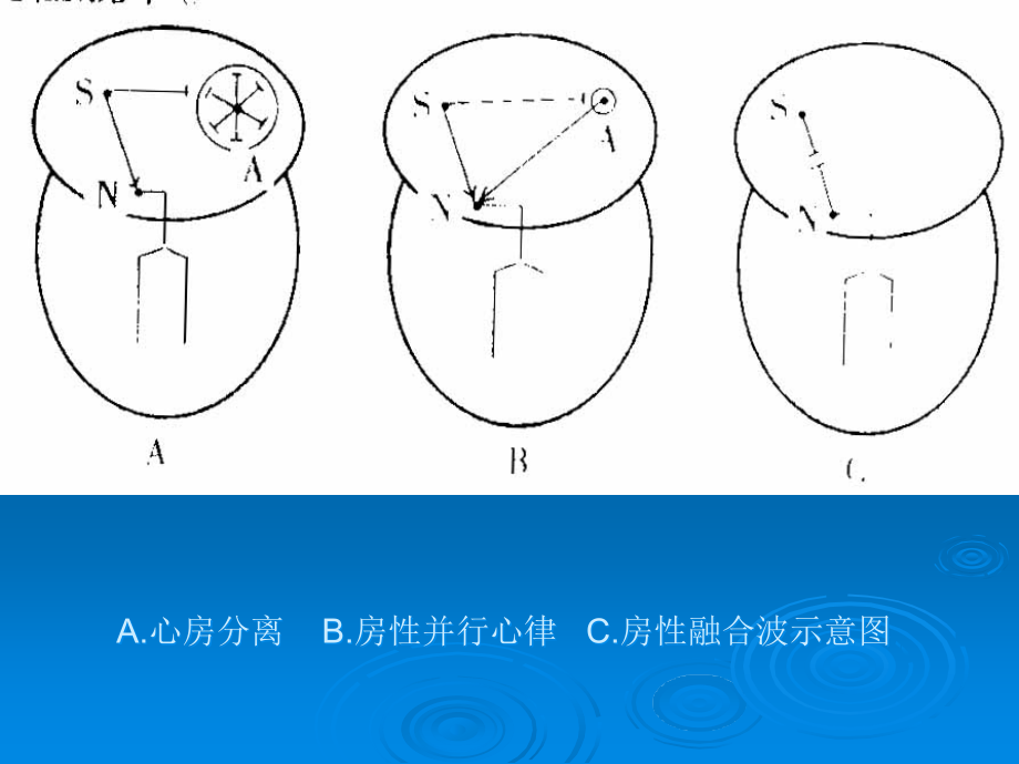 少见心电波形与临床意义_第4页