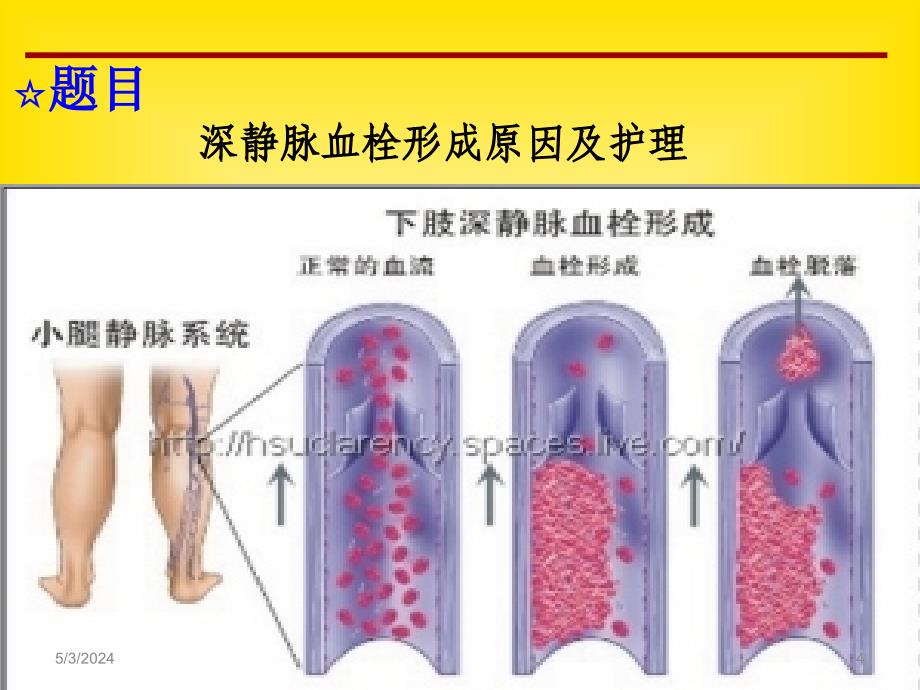 深静脉血栓形成原因与护理读书报告骨一科_第4页