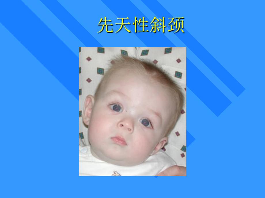 斜颈是小儿常见姿势畸形,可由多种病因引起可分为两种_第1页