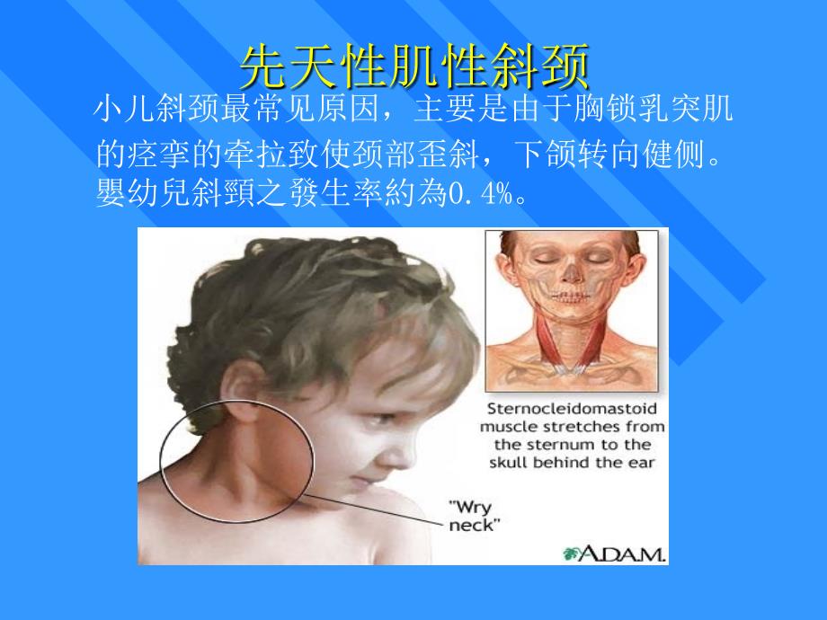 斜颈是小儿常见姿势畸形,可由多种病因引起可分为两种_第3页