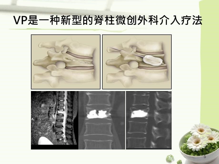 椎体成形术相关知识与术后护理_第5页