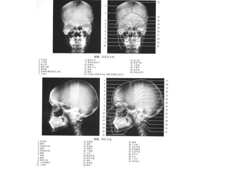 颅骨2病变_第5页