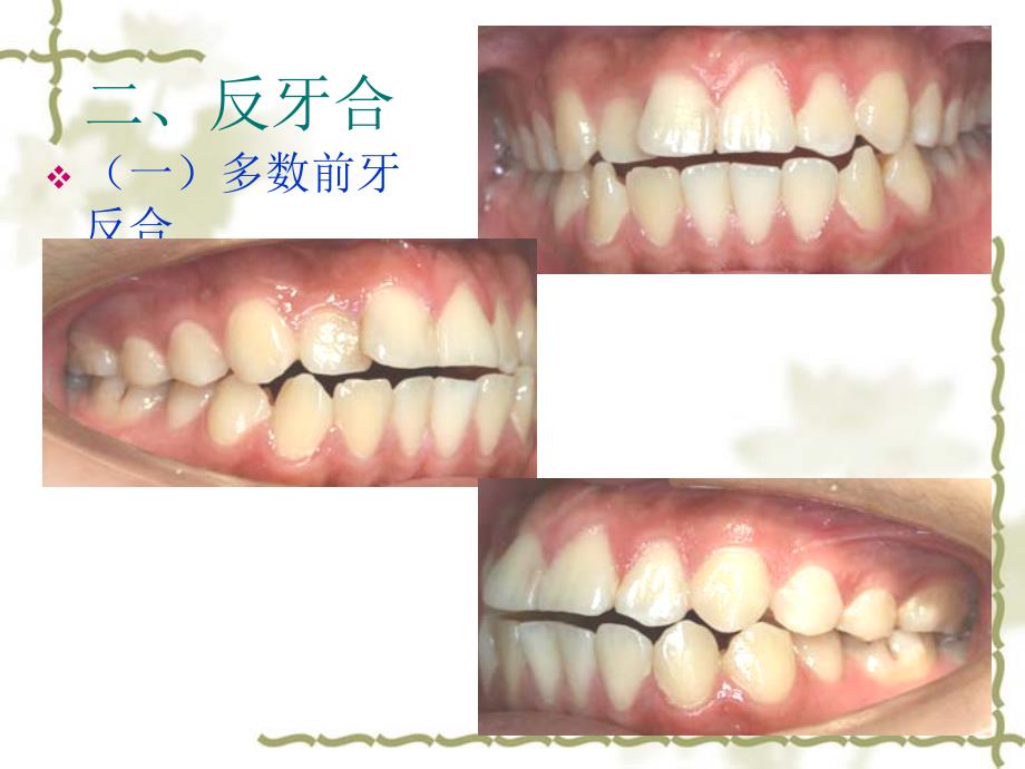 口腔正畸学 常见错合畸形的矫治二反合_第2页