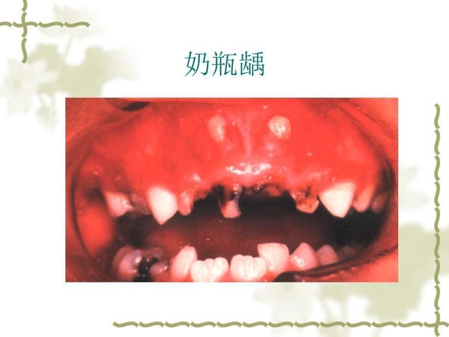 口腔正畸学 常见错合畸形的矫治二反合_第5页