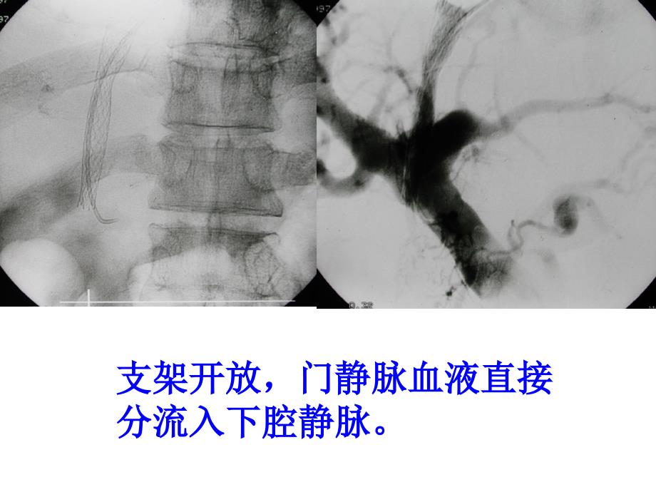 食管静脉曲张x线表现_第4页