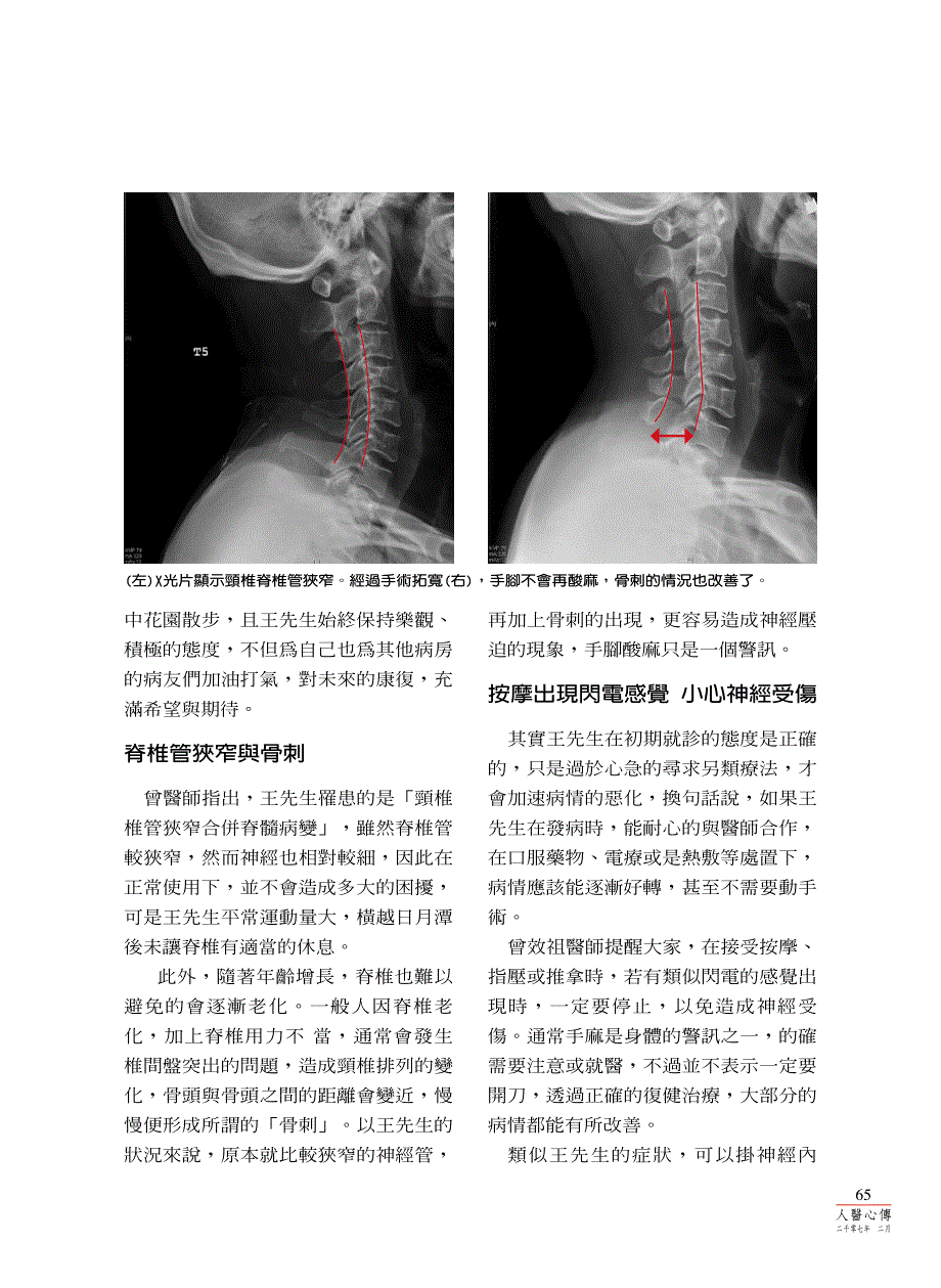 手脚酸麻是否脊椎太劳累_第2页