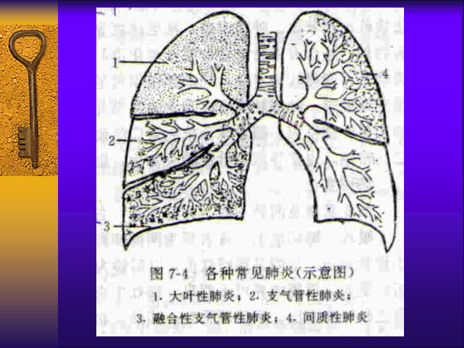 肺炎肿瘤结核_第2页