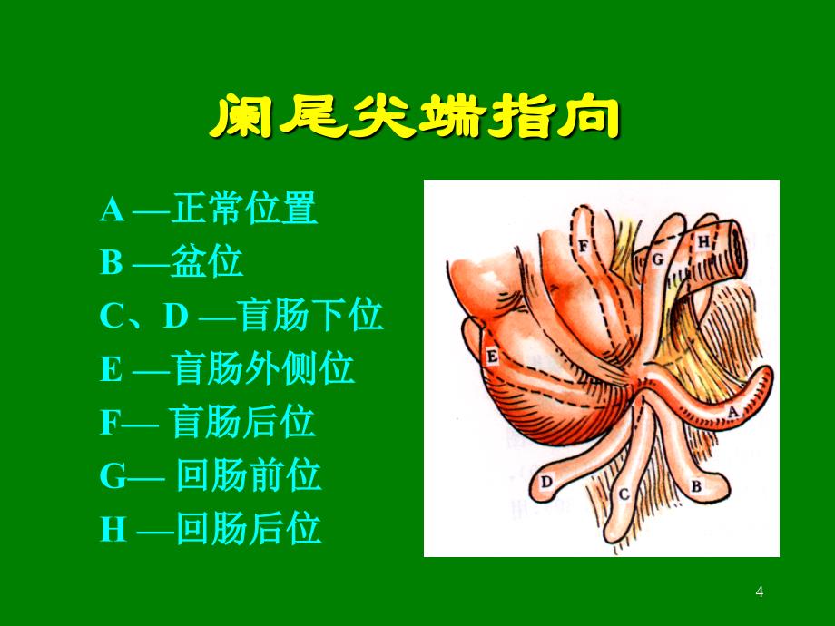 阑尾炎的诊断与治疗_第4页