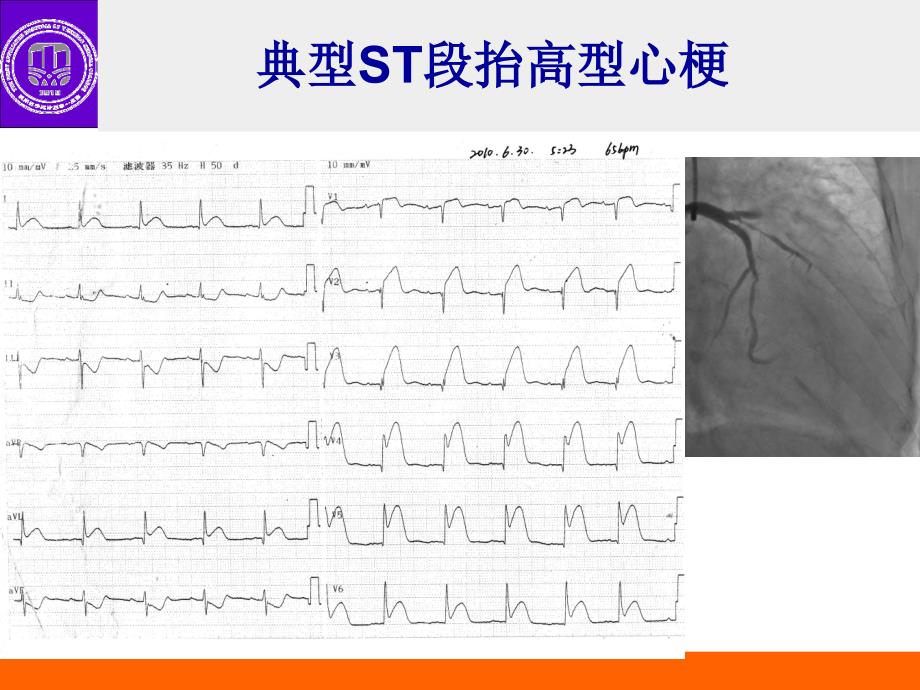 心梗不典型心电图表现_第2页