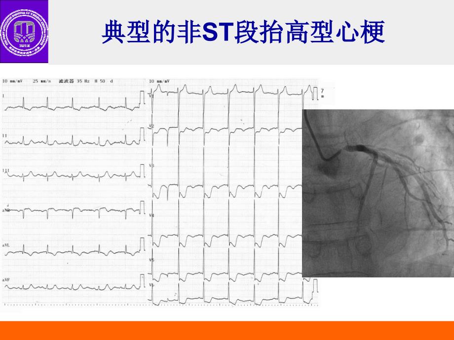 心梗不典型心电图表现_第3页