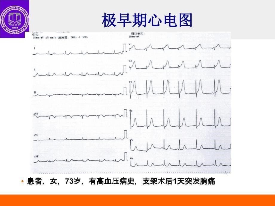 心梗不典型心电图表现_第5页