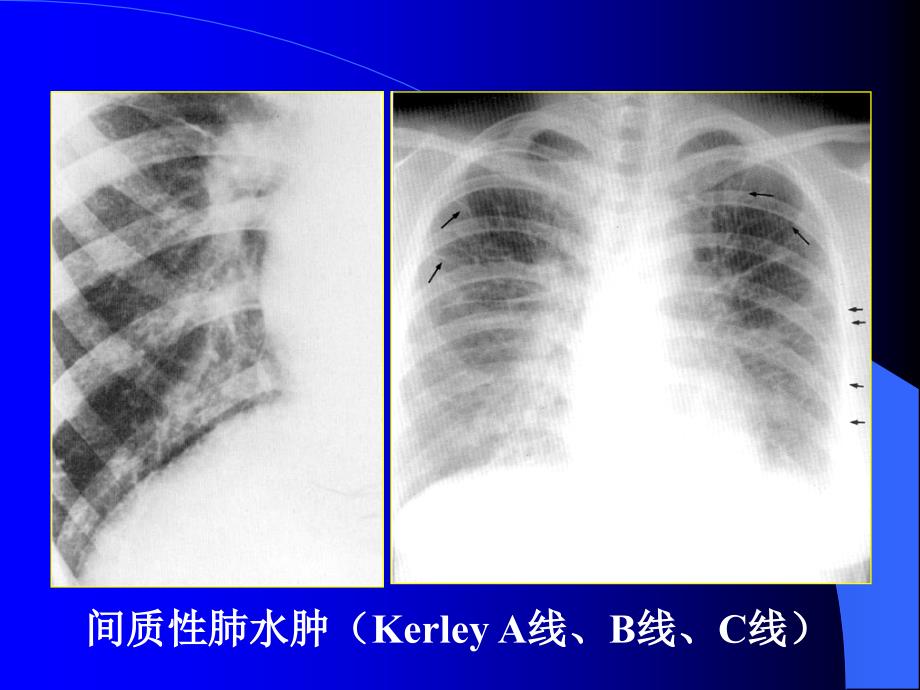 肺淤血的X线表现_第4页