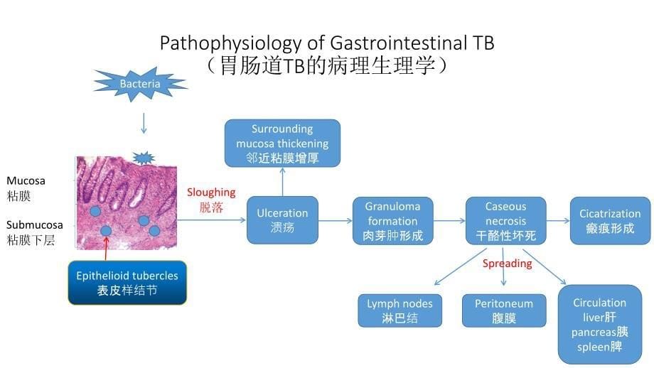 结核性腹膜炎_第5页