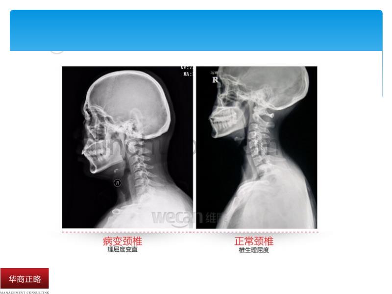 颈椎病健康小常识_第4页