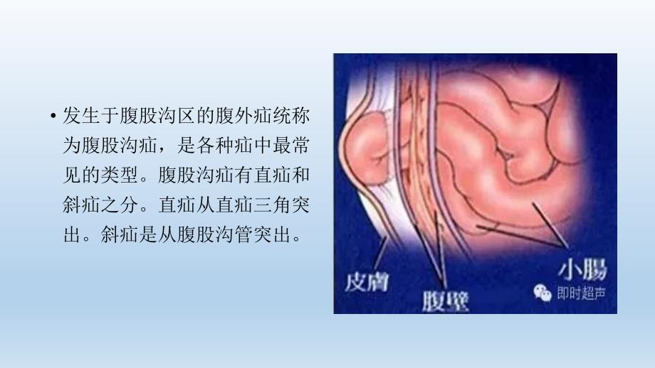 腹股沟疝超声诊断_第3页