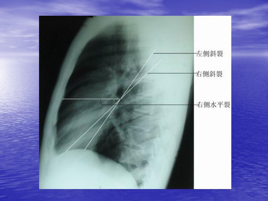 胸片上肺的分叶及右侧位片_第3页