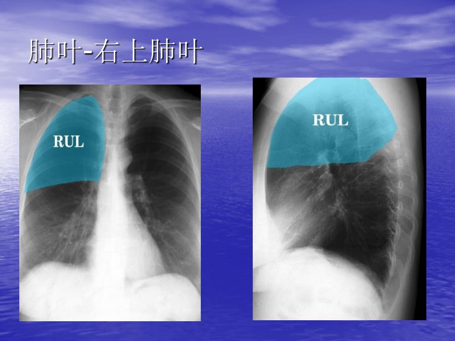 胸片上肺的分叶及右侧位片_第4页