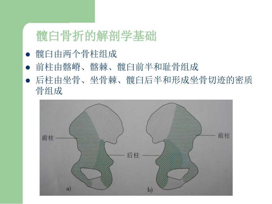 髋臼骨折的诊断治疗_第4页