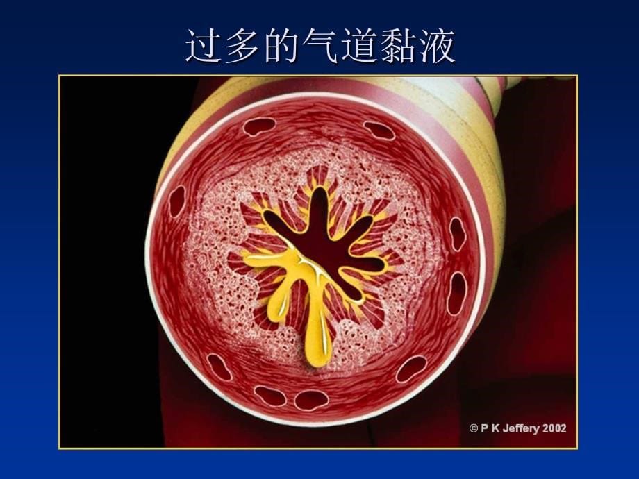 慢性支气管炎肺气肿(a)_第5页